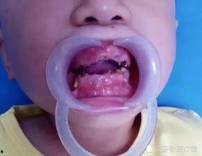 嘴巴烂的图片,图片解析口腔健康问题
